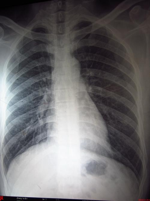 肺部x光片的相关图片